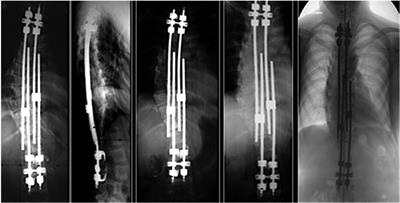 Effectiveness and safety of a one-yearly elongation approach of growing rods in the treatment of early-onset scoliosis: A case series of 40 patients with definitive fusion